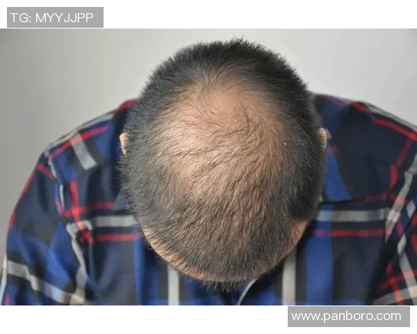 植发足球球星形象逆袭从稀疏发量到球场自信风采再现